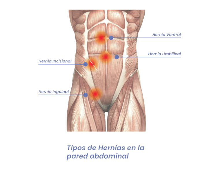 Hernias De La Pared Abdominal Dra Tabata Tinoco