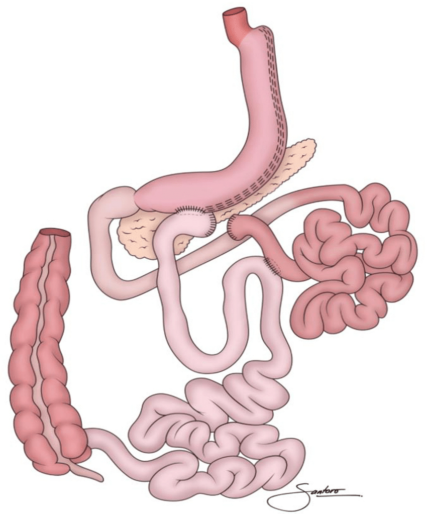 Diagrama Bipartición Intestinal