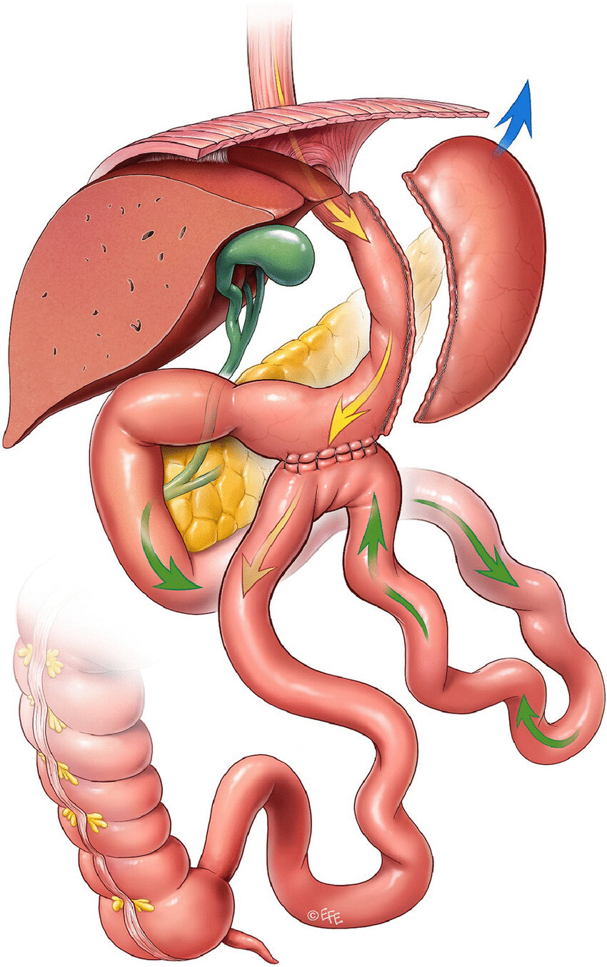 Anatomical Diagram SASI Bypass Bipartition